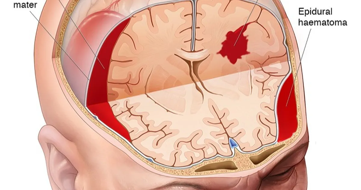 إصابات الدماغ الرضحية.. صدمات أو حوادث تؤدي لمضاعفات مزمنة
